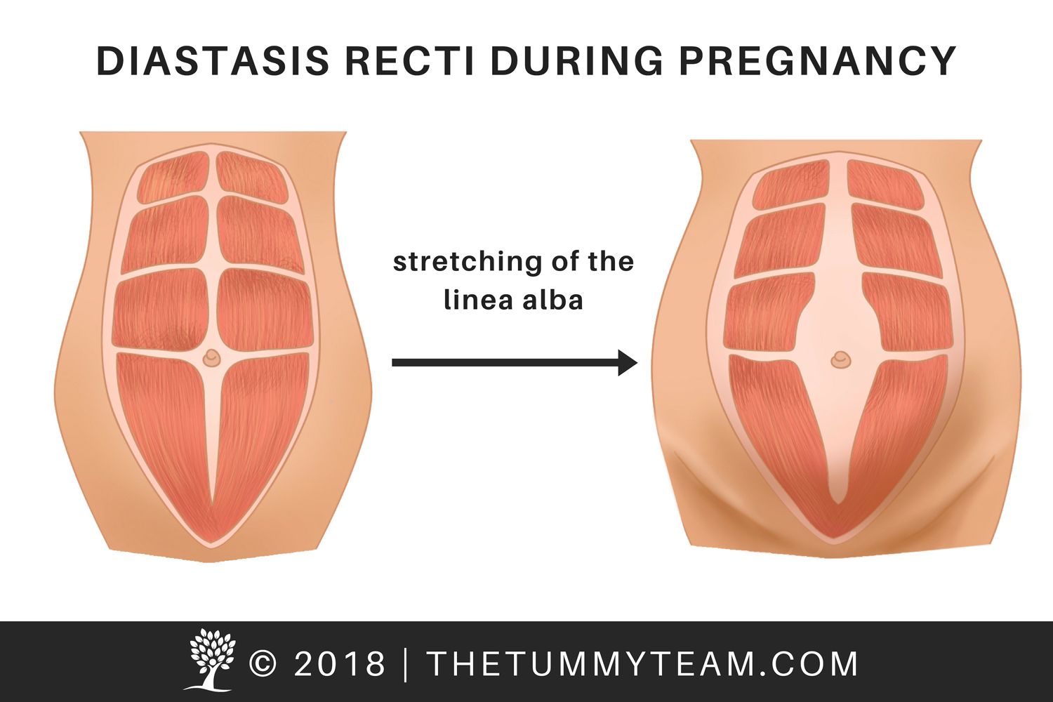 The Tummy Team - Diastasis Recti And Pelvic Floor Healing 7 Image
