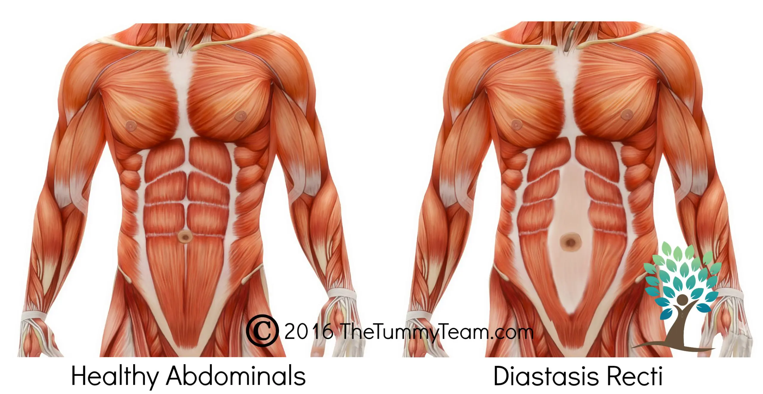 The Tummy Team - Diastasis Recti And Pelvic Floor Healing 8 Image