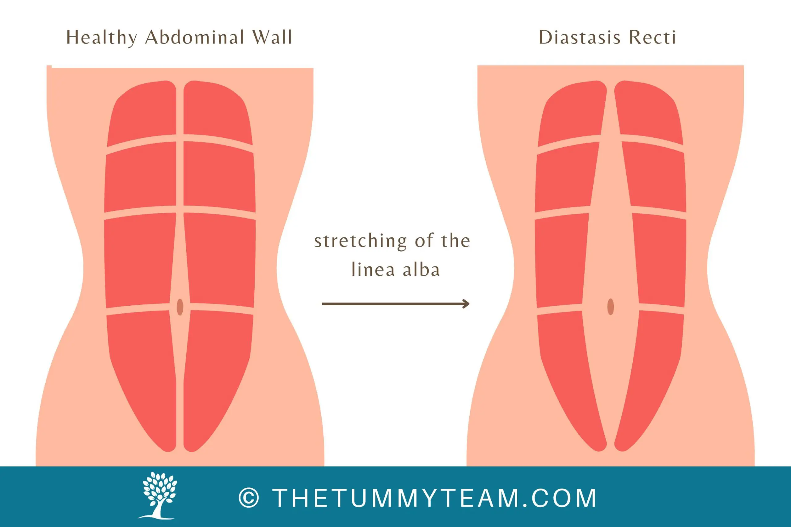The Tummy Team - Diastasis Recti And Pelvic Floor Healing 1 Image