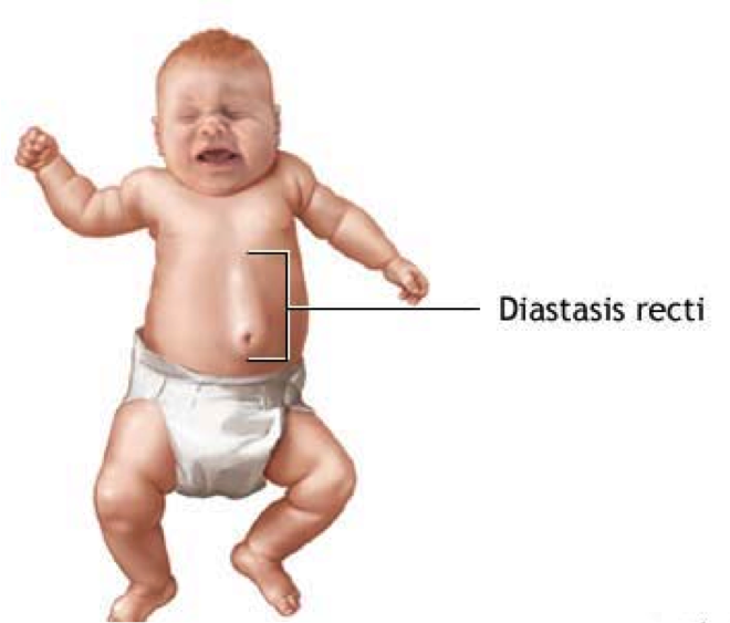The Tummy Team - Diastasis Recti And Pelvic Floor Healing 9 Image