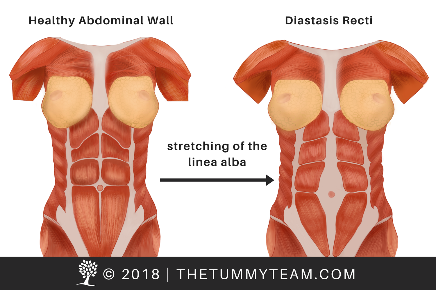 The Tummy Team - Diastasis Recti And Pelvic Floor Healing 6 Image