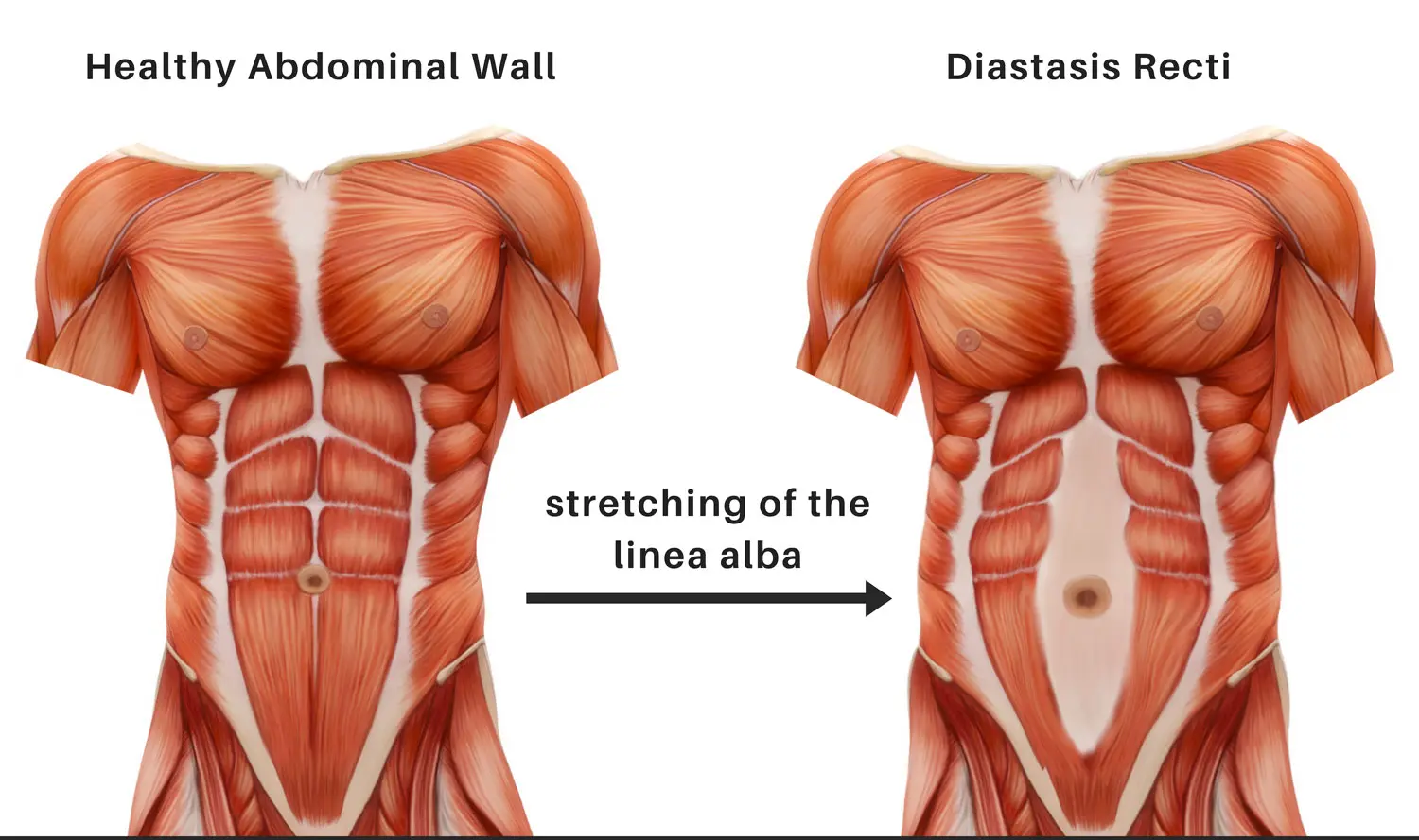 The Tummy Team - Diastasis Recti And Pelvic Floor Healing 2 Illustration of Diastasis Recti in Men